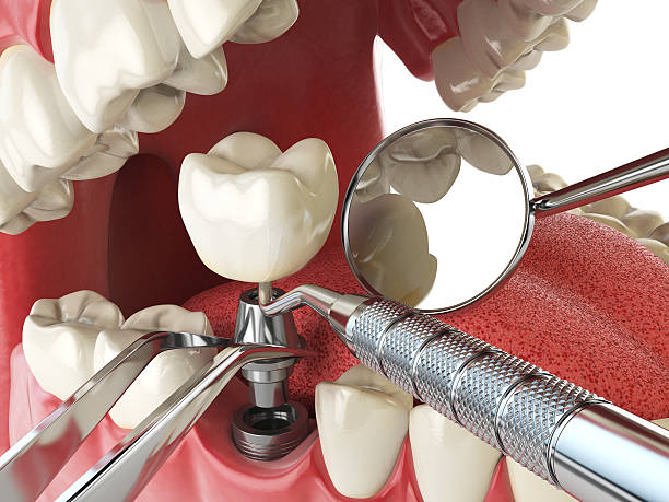 Best Emergency Broken Tooth Repair in Ferndale, WA